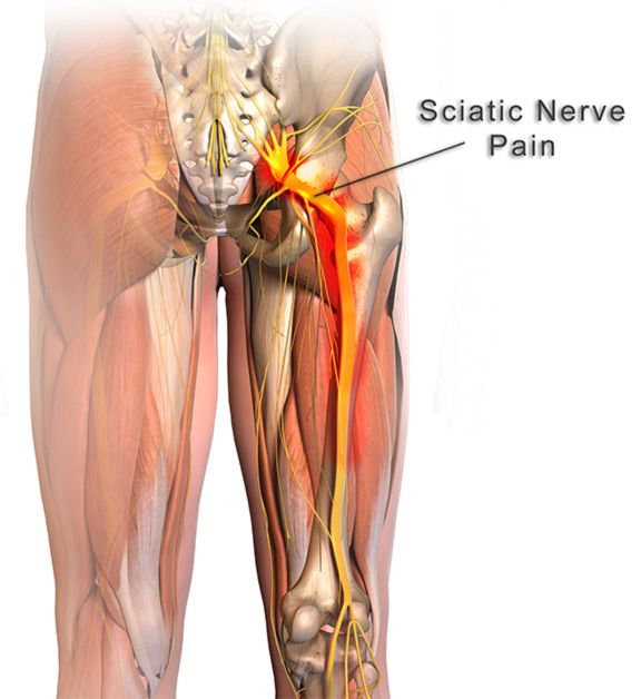 SCIATICA PAIN RELIEF THERAPY